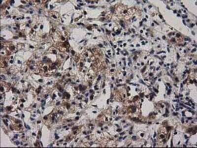 Immunohistochemistry: Adenylosuccinate Lyase Antibody (OTI2D10) - Azide and BSA Free [NBP2-70101] - Staining of paraffin-embedded Carcinoma of Human kidney tissue using anti-Adenylosuccinate Lyase mouse monoclonal antibody.