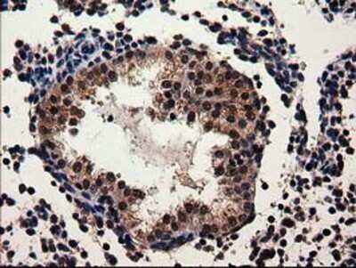 Immunohistochemistry: Adenylosuccinate Lyase Antibody (OTI2D10) - Azide and BSA Free [NBP2-70101] - Staining of paraffin-embedded Carcinoma of Human prostate tissue using anti-Adenylosuccinate Lyase mouse monoclonal antibody.