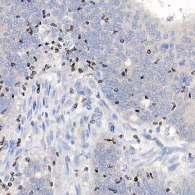 Immunohistochemistry-Paraffin: Aiolos/IKZF3 Antibody (4V2Z2) [NBP3-16668] - Immunohistochemistry of paraffin-embedded human colon carcinoma using Aiolos/IKZF3 antibody (NBP3-16668) at dilution of 1:100 (40x lens).Perform high pressure antigen retrieval with 10 mM citrate buffer pH 6.0 before commencing with IHC staining protocol.