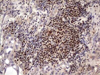 Immunohistochemistry: Aiolos/IKZF3 Antibody (7E11) [NBP2-46048] - Analysis of Carcinoma of Human lung tissue.(Heat-induced epitope retrieval by 1 mM EDTA in 10mM Tris, pH8.5, 120C for 3min)