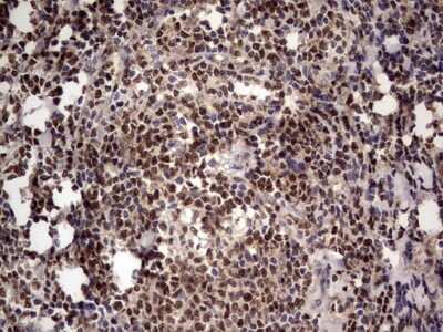 Immunohistochemistry: Aiolos/IKZF3 Antibody (7E11) [NBP2-46048] - Analysis of Human lymphoma tissue. (Heat-induced epitope retrieval by 1 mM EDTA in 10mM Tris, pH8.5, 120C for 3min)