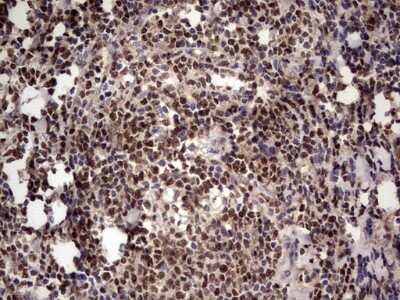 Immunohistochemistry: Aiolos/IKZF3 Antibody (OTI7E11) - Azide and BSA Free [NBP2-71698] - Analysis of Human lymphoma tissue. (Heat-induced epitope retrieval by 1 mM EDTA in 10mM Tris, pH8.5, 120C for 3min)