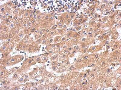 Immunohistochemistry: Alanyl tRNA synthetase Antibody [NBP1-31706] - Paraffin-embedded hepatoma; antibody dilution 1:500.