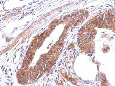 Immunohistochemistry-Paraffin: Alanyl tRNA synthetase Antibody [NBP2-15332] - Paraffin-embedded Hepatoma, using antibody at 1:500 dilution.