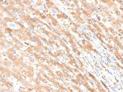 Immunohistochemistry-Paraffin: Albumin Antibody (ALB/6411R) - Azide and BSA Free [NBP3-08917] - Formalin-fixed, paraffin-embedded human liver carcinoma in colon stained with Albumin Recombinant Rabbit Monoclonal Antibody (ALB/6411R).