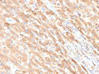 Immunohistochemistry-Paraffin: Albumin Antibody (ALB/6411R) [NBP3-07174] - Formalin-fixed, paraffin-embedded human liver carcinoma in colon stained with Albumin Recombinant Rabbit Monoclonal Antibody (ALB/6411R).