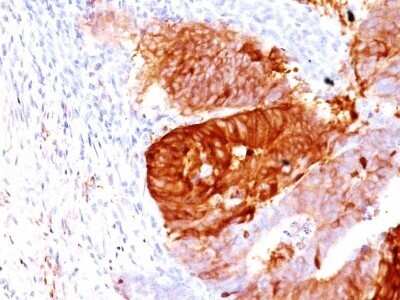 Immunohistochemistry-Paraffin: Aldehyde Dehydrogenase 1-A1/ALDH1A1 Antibody (ALDH1A1/1381) - Azide and BSA Free [NBP2-54422] - Formalin-fixed, paraffin-embedded Human Colon Carcinoma stained with ALDH1A1 Monoclonal Antibody (ALDH1A1/1381).