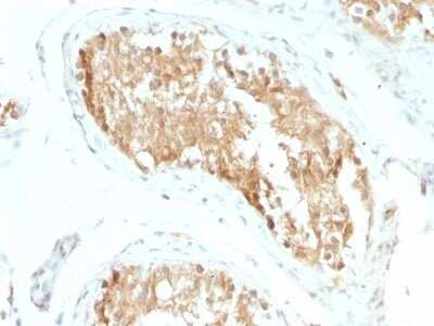 Immunohistochemistry-Paraffin: Aldehyde Dehydrogenase 1-A1/ALDH1A1 Antibody (ALDH1A1/1381) - Azide and BSA Free [NBP2-54422] - Formalin-fixed, paraffin-embedded Human Testicular Carcinoma stained with ALDH1A1 Monoclonal Antibody (ALDH1A1/1381).