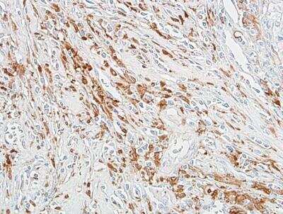 Immunohistochemistry: Aldehyde Dehydrogenase 1-A1/ALDH1A1 Antibody (BLR089G) [NBP2-80139] - Detection of human ALDH1A1 in FFPE breast carcinoma by IHC. Antibody: Rabbit anti-ALDH1A1 recombinant monoclonal [BLR089G] (NBP2-80139). Secondary: HRP-conjugated goat anti-rabbit IgG. Substrate: DAB.
