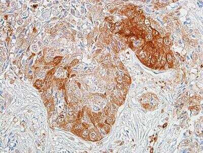 Immunohistochemistry: Aldehyde Dehydrogenase 1-A1/ALDH1A1 Antibody (BLR089G) [NBP2-80139] - Detection of human ALDH1A1 in FFPE lung carcinoma by IHC. Antibody: Rabbit anti-ALDH1A1 recombinant monoclonal [BLR089G] (NBP2-80139). Secondary: HRP-conjugated goat anti-rabbit IgG. Substrate: DAB.