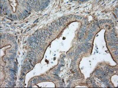 Immunohistochemistry: Aldehyde Dehydrogenase 3-A1/ALDH3A1 Antibody (OTI1B6) - Azide and BSA Free [NBP2-70152] - Staining of paraffin-embedded Adenocarcinoma of colon tissue using anti-ALDH3A1 mouse monoclonal antibody.