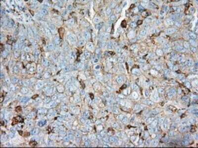 Immunohistochemistry: Aldehyde Dehydrogenase 3-A1/ALDH3A1 Antibody (OTI1B6) - Azide and BSA Free [NBP2-70152] - Staining of paraffin-embedded Adenocarcinoma of ovary tissue using anti-ALDH3A1 mouse monoclonal antibody.