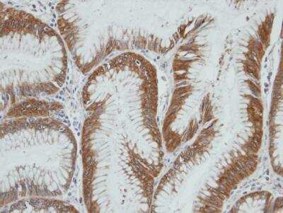 Immunohistochemistry-Paraffin: Aldo-keto Reductase 1C4/AKR1C4 Antibody [NBP1-31429] - Paraffin-embedded gastric ca, using antibody at 1:100 dilution.