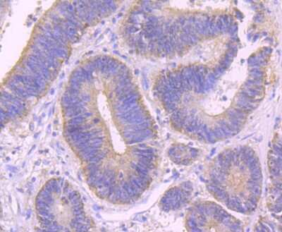 Immunohistochemistry-Paraffin: Alix Antibody (JM85-31) [NBP2-75403] - Analysis of paraffin-embedded human colon cancer tissue using anti-ALIX antibody. Counter stained with hematoxylin.