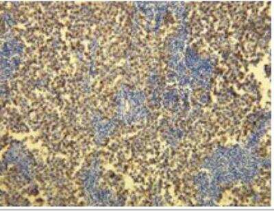 Immunohistochemistry-Paraffin: Alkaline Phosphatase/ALPP Antibody (P16-D) [NBP1-30149] - Diffuse cytoplasmic PLAP positivity in the typical seminoma. Formalin fixed, paraffin embedded human tissue (4 um section) stained with anti-PLAP antibody.