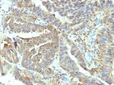 Immunohistochemistry-Paraffin: Alkaline Phosphatase, Tissue Non-Specific Antibody (V17.1) - Azide and BSA Free [NBP2-47996] - Formalin-fixed, paraffin-embedded human Ovarian Carcinoma stained with Alkaline Phosphatase, Tissue Non-Specific Antibody (V17.1).