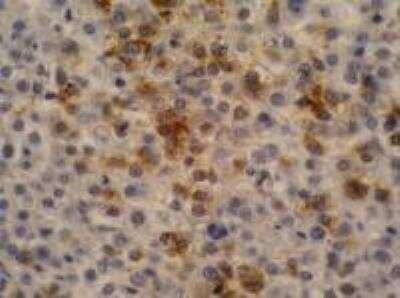 Immunohistochemistry-Paraffin: alpha-Fetoprotein/AFP Antibody (AFP-11) [NB500-524] - Staining of hepatocellular carcinoma (fetal liver; paraffin-embedded sections)