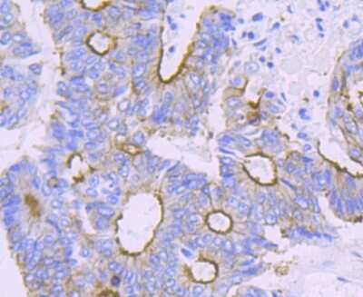 Immunohistochemistry-Paraffin: Alpha Actinin 4 Antibody (JU20-23) [NBP2-75404] - Analysis of paraffin-embedded human colon cancer tissue using anti-alpha Actinin 4 antibody. Counter stained with hematoxylin.