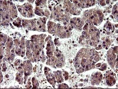 Immunohistochemistry: Alpha-parvin/Actopaxin Antibody (OTI1C10) [NBP2-46326] - Analysis of Carcinoma of Human liver tissue.(Heat-induced epitope retrieval by 10mM citric buffer, pH6.0, 120C for 3min)