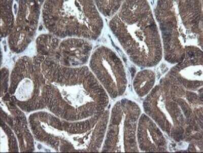 Immunohistochemistry: AlphaA Crystallin/CRYAA Antibody (OTI3B12) - Azide and BSA Free [NBP2-70450] - Analysis of Adenocarcinoma of Human endometrium tissue.