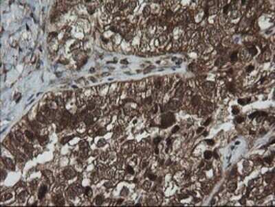 Immunohistochemistry: AlphaA Crystallin/CRYAA Antibody (OTI3B12) - Azide and BSA Free [NBP2-70450] - Analysis of Adenocarcinoma of Human ovary tissue.