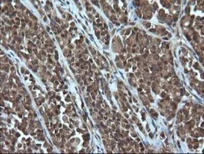 Immunohistochemistry: AlphaA Crystallin/CRYAA Antibody (OTI3B12) - Azide and BSA Free [NBP2-70450] - Analysis of Carcinoma of Human thyroid tissue.