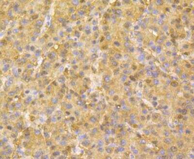 Immunohistochemistry-Paraffin: Aminoacylase/ACY1 Antibody [NBP2-89113] - Analysis of paraffin-embedded human liver cancer tissue using anti-ACY-1 antibody. The section was pre-treated using heat mediated antigen retrieval with Tris-EDTA buffer (pH 8.0-8.4) for 20 minutes.The tissues were blocked in 5% BSA for 30 minutes at room temperature, washed with ddH2O and PBS, and then probed with the antibody at 1/200 dilution, for 30 minutes at room temperature and detected using an HRP conjugated compact polymer system. DAB was used as the chrogen. Counter stained with hematoxylin and mounted with DPX.