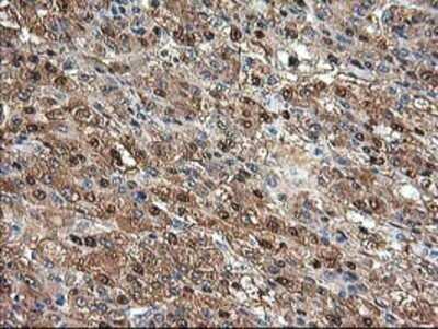 Immunohistochemistry: Aminoacylase/ACY1 Antibody (OTI1D4) - Azide and BSA Free [NBP2-70080] - Staining of paraffin-embedded Carcinoma of Human liver tissue using anti-Aminoacylase 1 mouse monoclonal antibody.