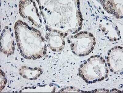 Immunohistochemistry: Aminoacylase/ACY1 Antibody (OTI1D4) - Azide and BSA Free [NBP2-70080] - Staining of paraffin-embedded Carcinoma of Human prostate tissue using anti-Aminoacylase 1 mouse monoclonal antibody.