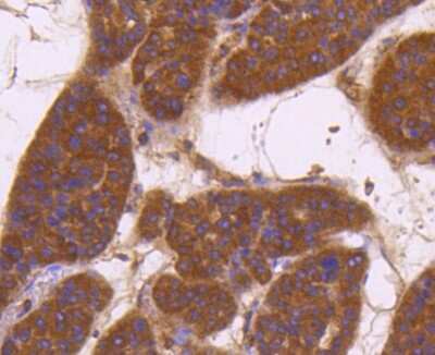 Immunohistochemistry-Paraffin: Aminopeptidase N/CD13 Antibody (SC70-01) [NBP2-67602] - Analysis of paraffin-embedded human liver cancer tissue using anti-CD13 antibody. Counter stained with hematoxylin.