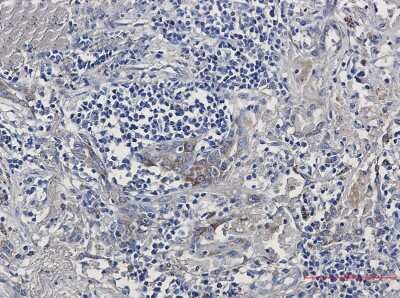 Immunohistochemistry-Paraffin: Aminopeptidase PILS/ARTS1 Antibody (S06-1H3) [NBP3-14916] - Immunohistochemistry of Aminopeptidase PILS/ARTS1 in paraffin-embedded Human lung cancer tissue using Aminopeptidase PILS/ARTS1 Rabbit mAb at dilution 1/50