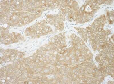 <b>Independent Antibodies Validation and Biological Strategies Validation.</b>Immunohistochemistry: Ancient ubiquitous protein 1 Antibody [NBP1-49916] - Sample: FFPE section of human ovarian carcinoma. Antibody: Affinity purified rabbit anti-AUP1 used at a dilution of 1:1,000 (1ug/ml). Detection: DAB