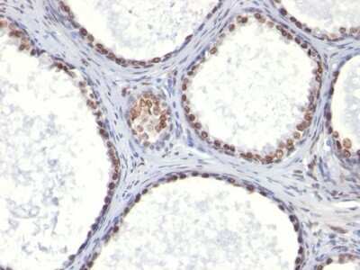 Immunohistochemistry-Paraffin: Androgen R/NR3C4 Antibody (AR441) - IHC-Prediluted [NBP2-48159] - Human Prostate Carcinoma stained with Androgen Receptor Monoclonal Antibody (AR441).