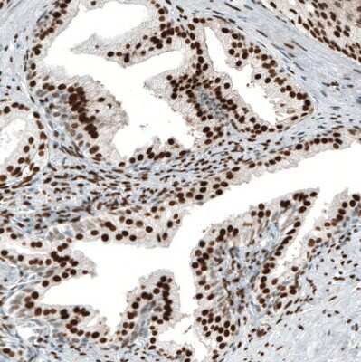 Immunohistochemistry-Paraffin: Androgen R/NR3C4 Antibody (CL9255) [NBP2-88922] - Staining of human prostate cancer shows strong nuclear positivity in tumor cells.