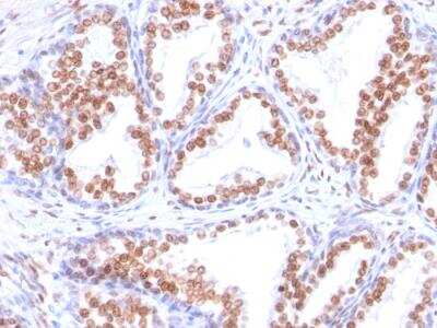 Immunohistochemistry-Paraffin: Androgen R/NR3C4 Antibody (DHTR/882) - Azide and BSA Free [NBP2-47856] - Human Prostate Carcinoma stained with Androgen Receptor Mouse Monoclonal Antibody (DHTR/882).