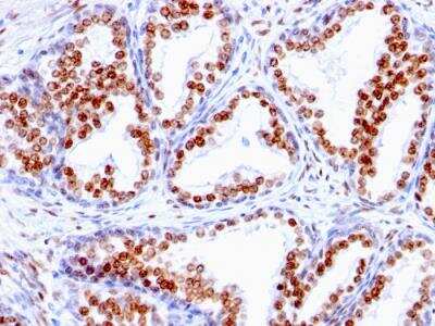 Immunohistochemistry-Paraffin: Androgen R/NR3C4 Antibody (SPM335) - Azide and BSA Free [NBP2-47855] - Human Prostate Carcinoma stained with Androgen Receptor monoclonal Antibody (SPM335).