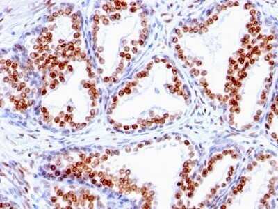 Immunohistochemistry-Paraffin: Androgen R/NR3C4 Antibody (SPM335) - IHC-Prediluted [NBP2-48160] - Human Prostate Carcinoma stained with Androgen Receptor Monoclonal Antibody (SPM335).