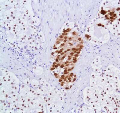 Immunohistochemistry-Paraffin: Androgen R/NR3C4 Antibody (SP107) [NBP2-12502] - Human Prostate Adenocarcinoma