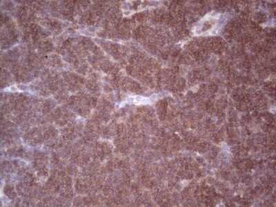 Immunohistochemistry: Angiopoietin-2 Antibody (3H7) [NBP2-46520] - Analysis of Human lymphoma tissue