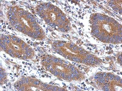 Immunohistochemistry-Paraffin: Angiopoietin 2 Antibody [NBP2-15386] - Paraffin-embedded Colon ca, using antibody at 1:500 dilution.