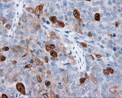 Immunohistochemistry-Paraffin: Annexin A1 Antibody (3A8) [NBP2-02357] - Staining of paraffin-embedded Adenocarcinoma of ovary tissue using anti-Annexin A1 mouse monoclonal antibody.