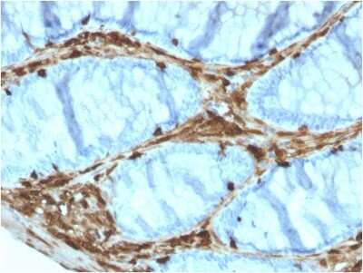 Immunohistochemistry-Paraffin: Annexin A1 Antibody (ANXA1/3566) [NBP3-07716] - Formalin-fixed, paraffin-embedded human Colon Carcinoma stained with Annexin A1 Mouse Monoclonal Antibody (ANXA1/3566).