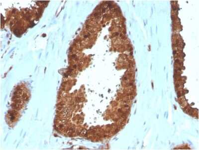 Immunohistochemistry-Paraffin: Annexin A1 Antibody (ANXA1/3566) [NBP3-08708] - Formalin-fixed, paraffin-embedded human Prostate Carcinoma stained with Annexin A1 Mouse Monoclonal Antibody (ANXA1/3566).