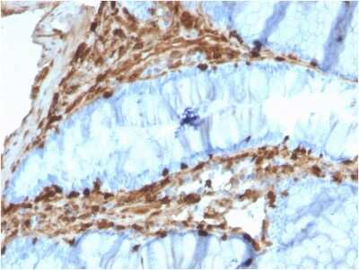 Immunohistochemistry-Paraffin: Annexin A1 Antibody (CPTC-ANXA1-1) - Azide and BSA Free [NBP3-08699] - Formalin-fixed, paraffin-embedded human Colon Carcinoma stained with Annexin A1 Mouse Monoclonal Antibody (CPTC-ANXA1-1).