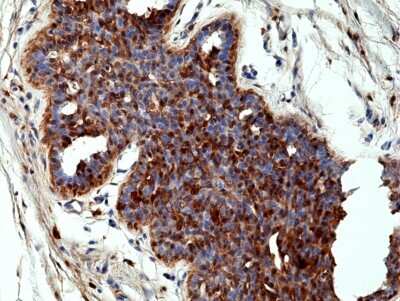 Immunohistochemistry-Paraffin: Annexin A1 Antibody (RM424) [NBP3-09177] - Immunohistochemical staining of formalin fixed and paraffin embedded human breast cancer tissue section using NBP3-09176 at a 1:100 dilution.
