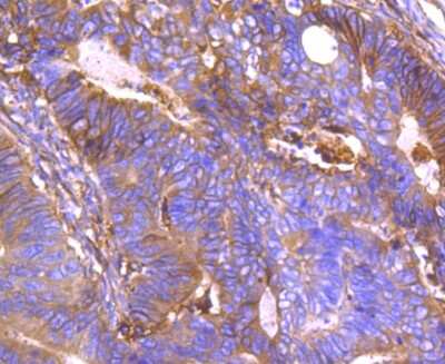 Immunohistochemistry-Paraffin: Annexin A2 Antibody (JA42-30) [NBP2-67155] - Analysis of paraffin-embedded human colon cancer tissue using anti-Annexin A2 antibody. Counter stained with hematoxylin.
