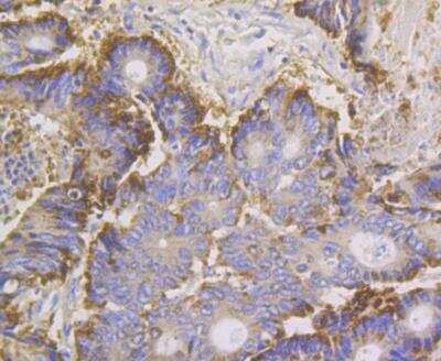 Immunohistochemistry: Annexin A4 Antibody (JG37-83) [NBP2-76976] - Immunohistochemical analysis of paraffin-embedded human colon cancer tissue using anti-Annexin IV antibody. Counter stained with hematoxylin.