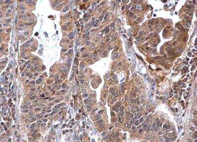 Immunohistochemistry-Paraffin: Annexin A7 Antibody [NBP1-31442] - Paraffin-embedded human gastric carcinoma dilution: 1:500.