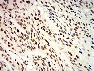 Immunohistochemistry: Apc10 Antibody (3E9A9) [NBP2-61888] - Analysis of paraffin-embedded esophageal cancer tissues using ANAPC10 mouse mAb with DAB staining.