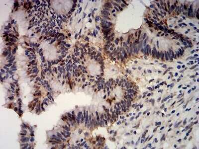 Immunohistochemistry: Apc10 Antibody (8F1D10) [NBP2-61889] - Analysis of paraffin-embedded colon cancer tissues using ANAPC10 mouse mAb with DAB staining.